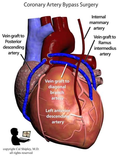 Coronary Artery Bypass Graft Blog Trial Image Inc