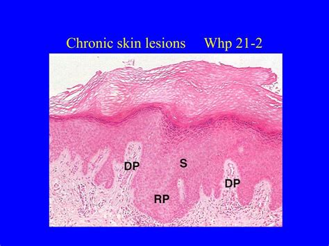 Ppt Skin Pathology Pigmented Lesions Neoplasms Immune Mediated