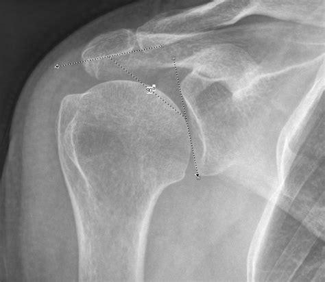 The Acromiohumeral Centre Edge Angle A New Radiographic Measurement