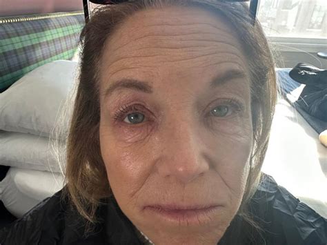 Katie Couric Opens Up About Her Eczema Battle With Makeup Free Selfie
