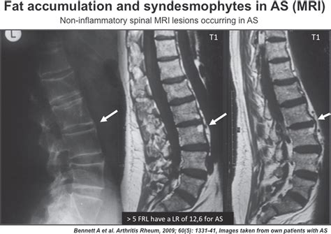 Ankylosing Spondylitis Mri