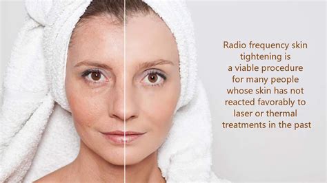 Radio Frequency Skin Tightening Treatment In Houston Texas Youtube