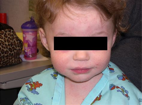 Atopic Eczema Affecting A Young Childs Face Download Scientific Diagram