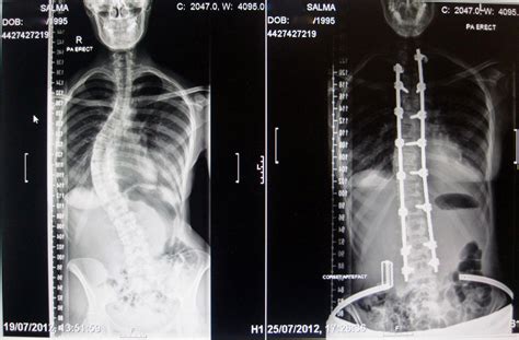 My Scoliosis And Spinal Fusion Journey 5 Years Post Surgery Very Detailed Rscoliosis