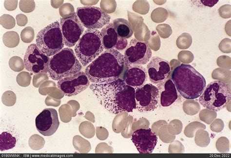 Stock Image Photomicrograph Of Chronic Myeloid Leukemia Cml Also Known