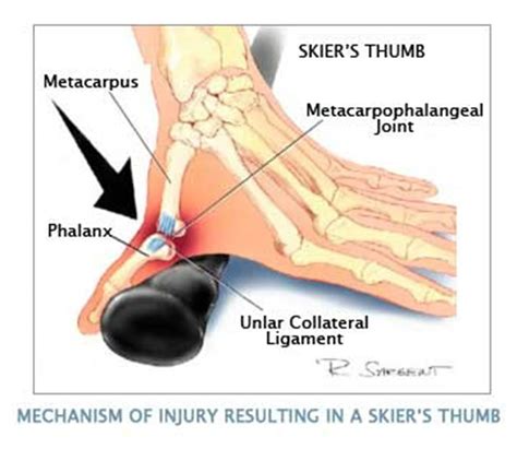 MRI NEWSLETTER Ulnar Collateral Ligament Injury Radius Imaging Thumb Pain Wrist Injury