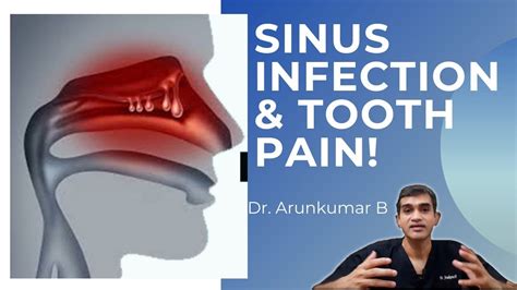 Sinusitis Can Sinus Infection Cause Tooth Ache Dr Arunkumar Pearls