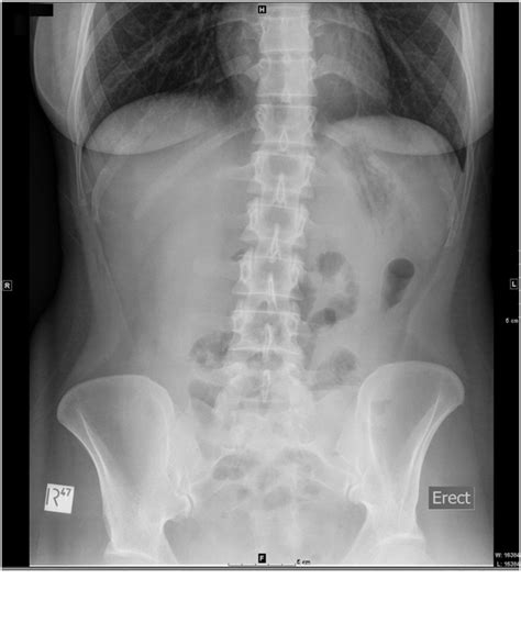 Both large and small bowel is demonstrated here and is normal. SWSLHD - Medical Imaging - Abdominal X-ray