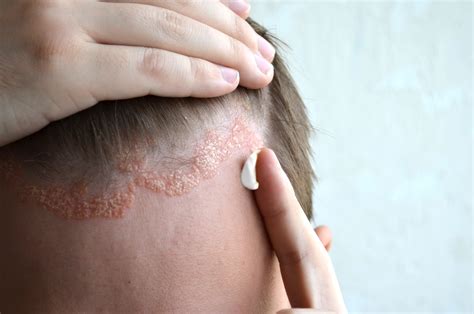 Scalp Psoriasis What Are The Causes And Treatments Elithair