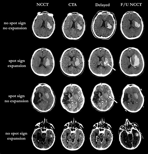 Spot And Diffuse Signs Quantitative Markers Of Intracranial Hematoma