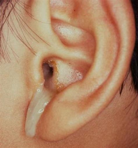 Infected Ear Drum