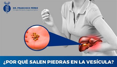 POR QUÉ SALEN PIEDRAS EN LA VESÍCULA CÁLCULOS BILIARES Cirujano