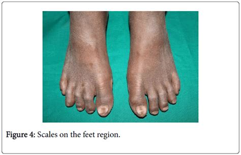 Medical Surgical Pathology Scales Feet Region