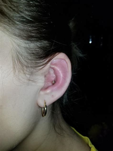 Infected Conch Piercing Rpiercingadvice