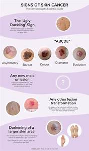 Skin Cancer Signs & Symptoms - The Dermatologist's Essential Guide Skin Cancer  