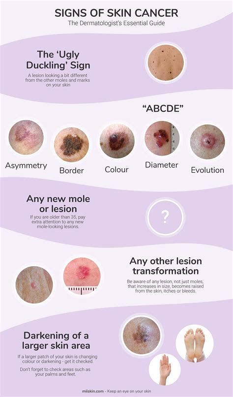 Skin Cancer Symptoms Pictures Photos Types Signs Melanoma Riset