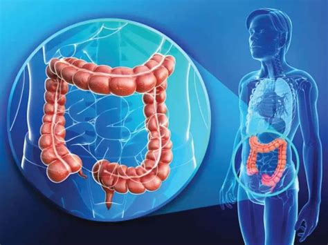 Colorectal Cancers On A Rise Signs And Treatment Mio Hospital