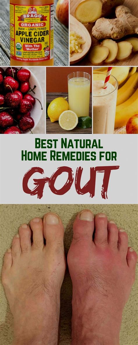 Pin By Marisol De Jesus Yu On Home Remedies Gout Remedies Home