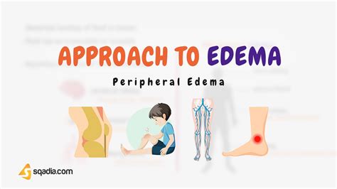 Approach To Edema