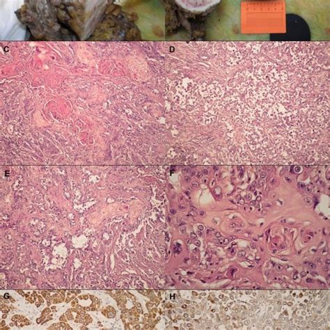 Pdf Primary Acantholytic Squamous Cell Carcinoma Of The Cecum A Case