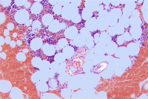 Pathology Outlines Plasma Cell Myeloma Multiple Myeloma