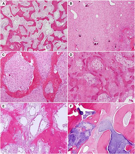 Polyostotic Fibrous Dysplasia Histology