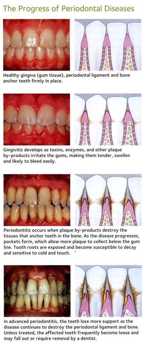 Periodontal Disease Progression Dental Assistant Study Dental Hygiene Babe Dental Clinic