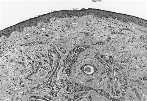Pathology Outlines Sebaceous Carcinoma Eyelid