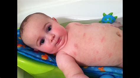 Baby Eczema Baby Atopic Dermatitis Eczema Dermatitis Rash Treatment
