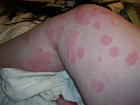 Itchy Rash From Stress Hot Sex Picture