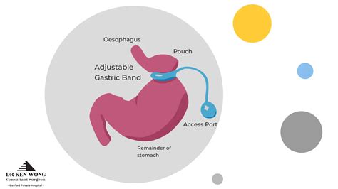 Lap Band Surgery Cost Australia Gastric Band Surgery Cost Explained