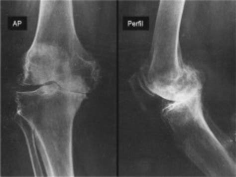The image is available for download in high resolution quality up to 5756x4827. Right knee radiograph, anteroposterior (AP) and lateral ...