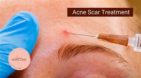 Prp Acne Scar Treatments In Vancouver What You Need To Know