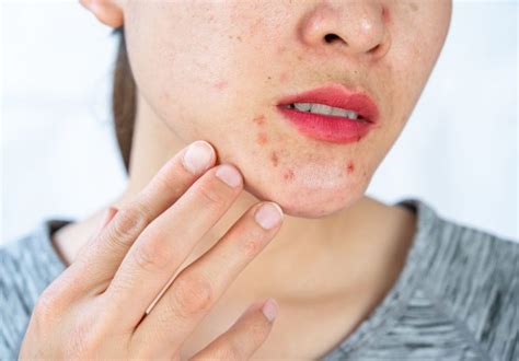 Pimples On Chin Meaning Causes And Natural Treatment