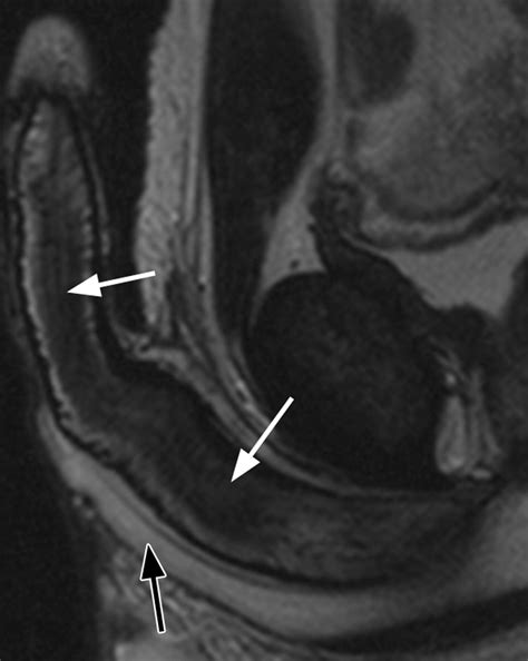 Mr Imaging Of Nonmalignant Penile Lesions Radiographics