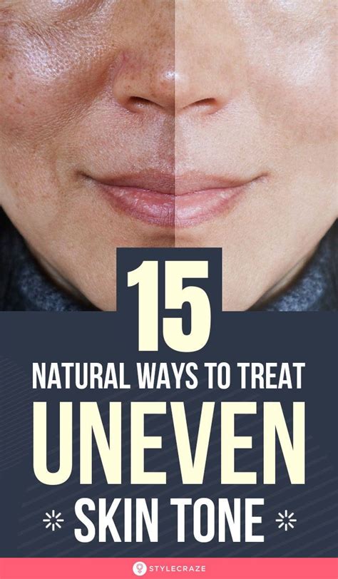 Uneven Skin Tone Tips To Get Rid Of It Naturally In 2020 Uneven Skin