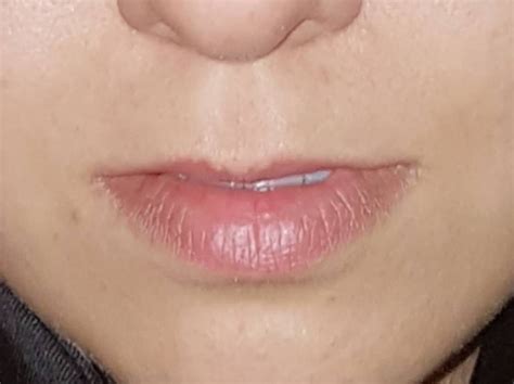 Augmentation de la lèvre supérieure par un lifting ...