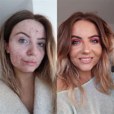 This Foundation Is Going Viral After Cystic Acne Sufferer Shares Her Amazing Before And After