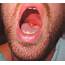 Causes And Treatment For A Swollen Uvula With Pictures  YouMeMindBody