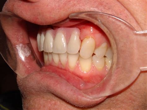 Dental Implants Replacing Teeth Barrie Dr Dove Dental Office
