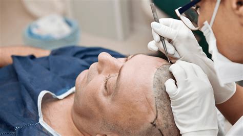 Common Myths About Hair Transplant And The Real Facts Radiant Skin Clinics