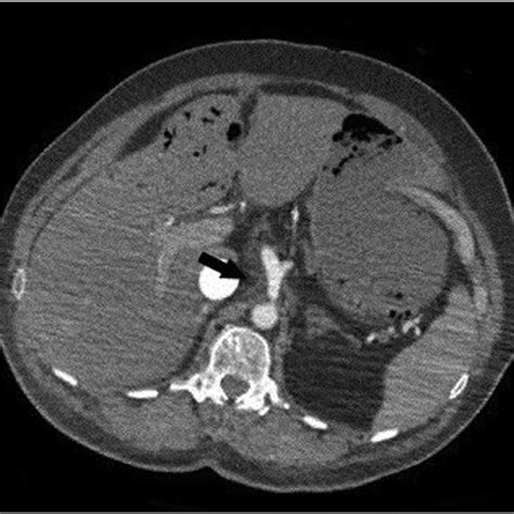 Contrast Enhanced Axial Ct Scan Of The Abdomen In The Portal Venous