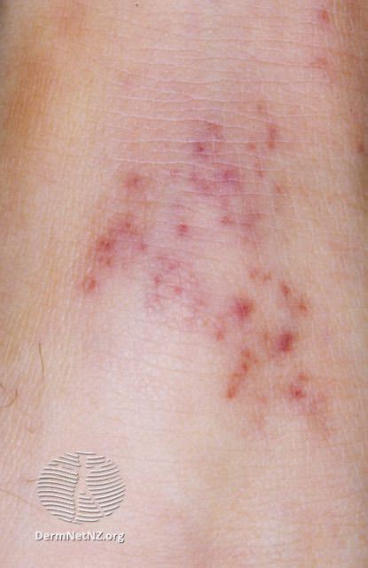 Bacterial Meningitis Rash Appearance Causes And When Its An Emergency