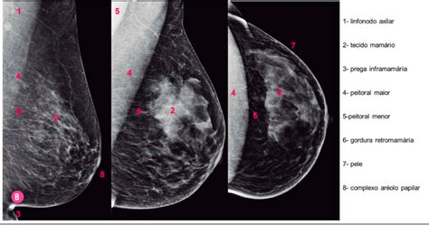 Mamografia E Ecografia Mam Ria Aplicabilidade Na Pr Tica M Dica Colunistas Sanar Medicina