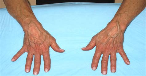 Sudden Bulging Veins In Hands Causes Symptoms And Treatment