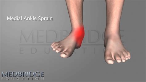 Medial Ankle Sprain