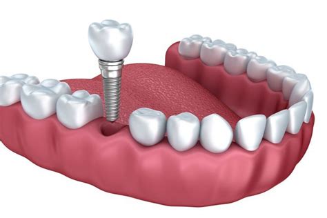 Dental Implants At Hereford Dental And Implant Clinic