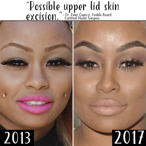 Blac Chyna Plastic Surgery Transformation Before After Photos