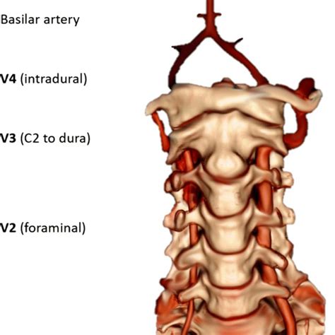 Vertebral Artery Anatomy Used With Permission From Frank Gaillard