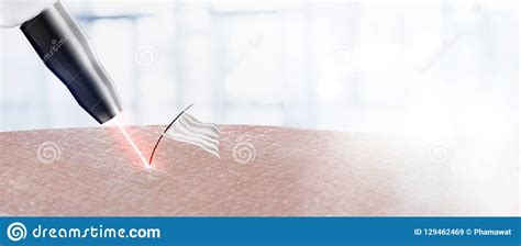 Cosmetology Procedure Laser Acne Removal On Body Partshair Surrender